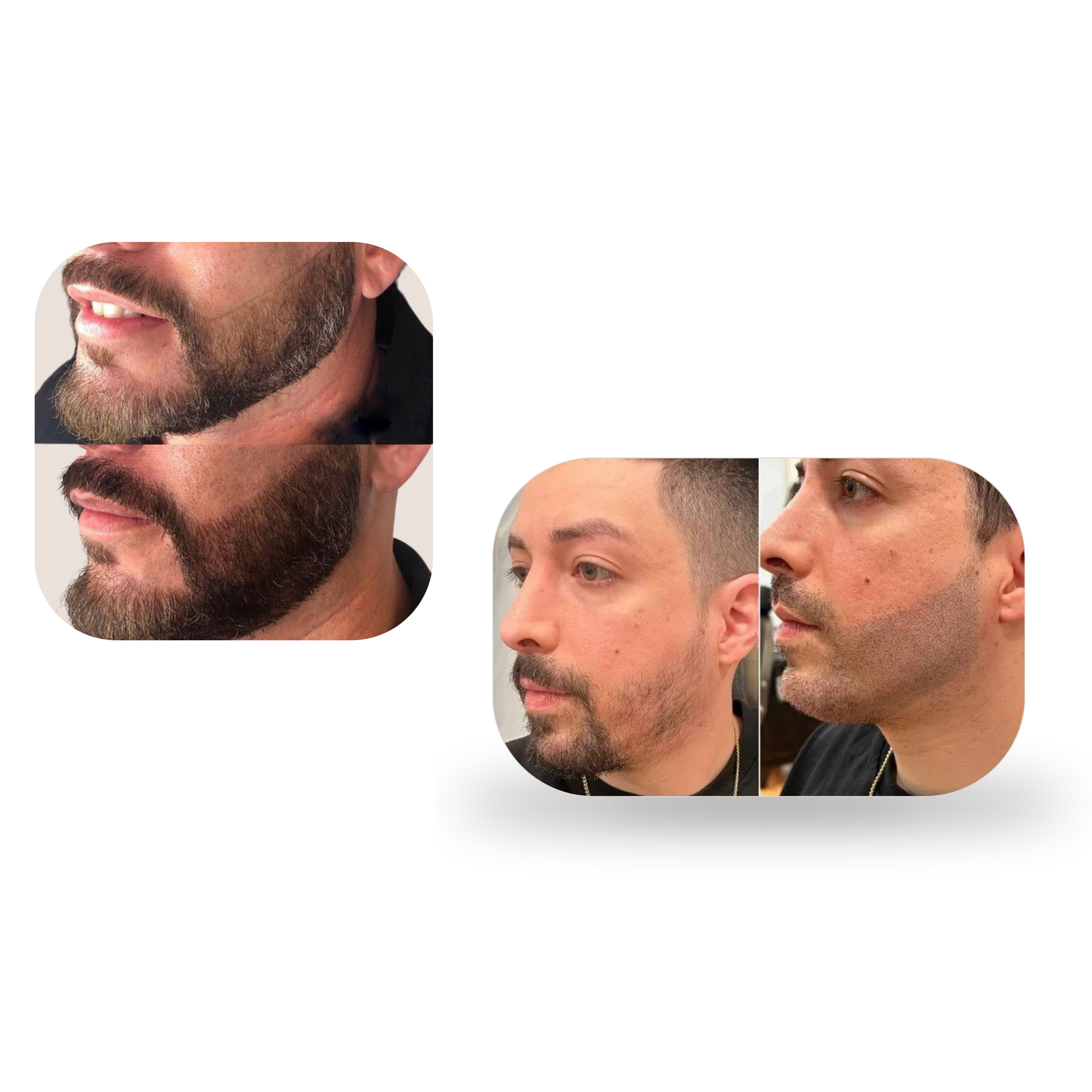 image montrant le resultat de la tricopigmentation de la barbe